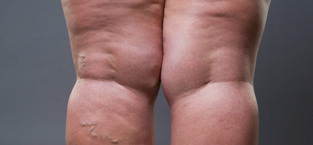 lipedema