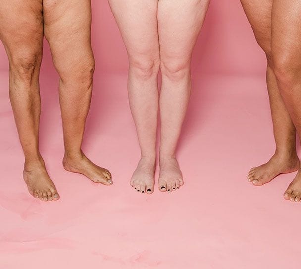 lipedema que es