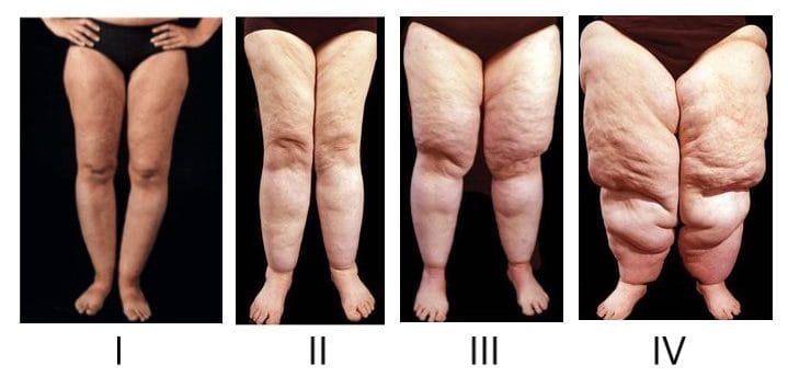 Grados lipedema