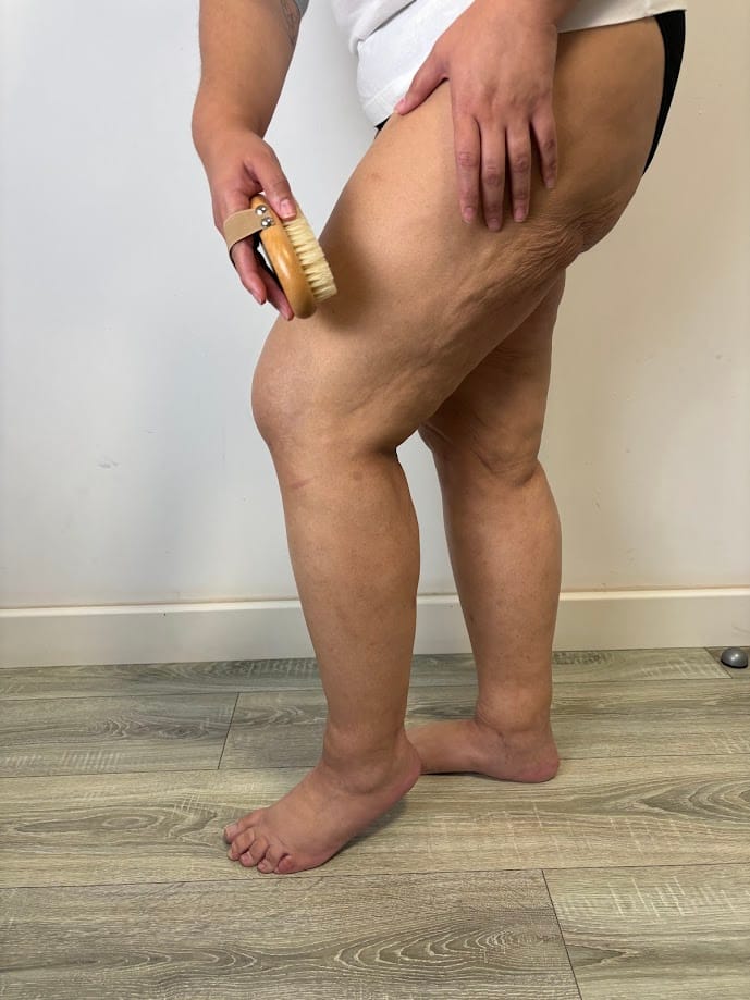 cepillo para cepillado en seco para lipedema linfodrenante
